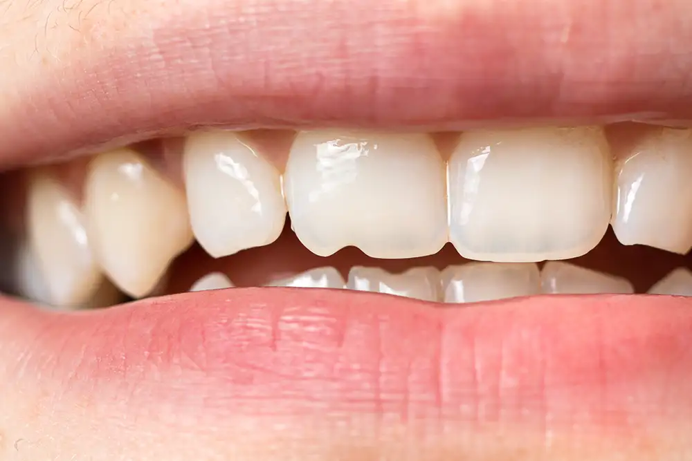 Close-up of a chipped front tooth, a common dental emergency