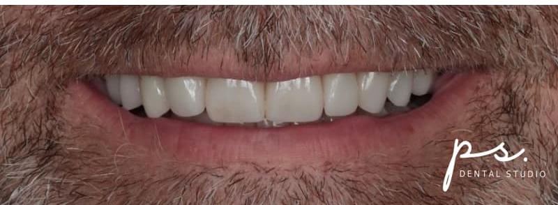 Close-up of the same patient's upper front teeth after porcelain veneers, showing restored length, width, and even proportions