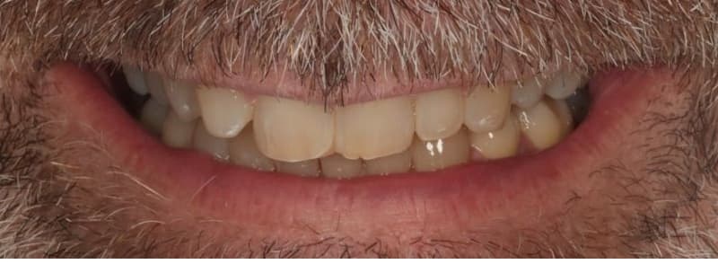 Close-up of a patient's upper front teeth before porcelain veneer treatment at PS Dental Studio in Kenmore, showing short, narrow tooth proportions